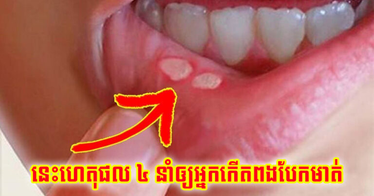 Hay Bi Nhiet Mieng Canh Bao Nguy Co Mac Benh Gi 4